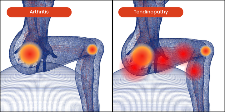 Tendinopathy VS Arthritis